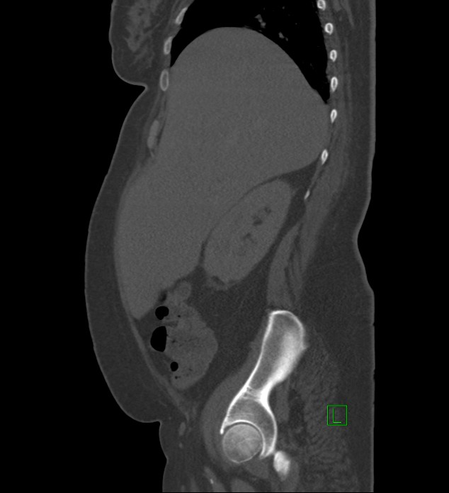 Chromophobe renal cell carcinoma (Radiopaedia 84239-99519 Sagittal bone window 81).jpg