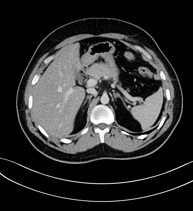 Chromophobe renal cell carcinoma (Radiopaedia 84286-99573 G 18).jpg
