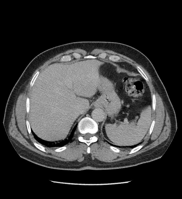 Chromophobe renal cell carcinoma (Radiopaedia 86879-103083 D 21).jpg