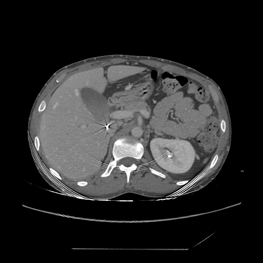 File:Chronic IVC thrombosis and resultant IVC filter malposition (Radiopaedia 81158-94800 A 56).jpg