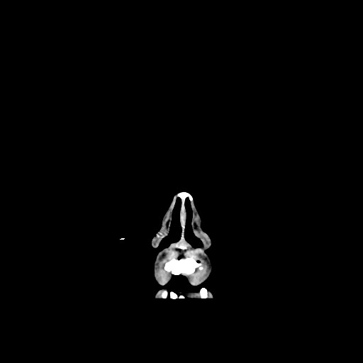 Chronic bilateral subdural hygroma (Radiopaedia 85801-101622 Coronal non-contrast 10).jpg