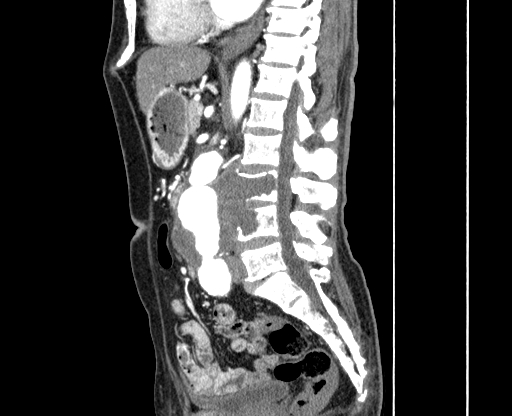 Chronic contained rupture of abdominal aortic aneurysm with extensive erosion of the vertebral bodies (Radiopaedia 55450-61901 B 30).jpg