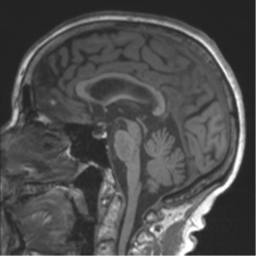Chronic hypertensive encephalopathy (Radiopaedia 39993-42482 Sagittal T1 48).png