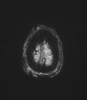 Chronic hypertensive encephalopathy (Radiopaedia 72844-83495 Axial SWI magnitude 82).png