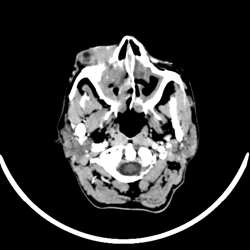 Chronic invasive fungal sinusitis with intraorbital and intracranial extension (Radiopaedia 56387-63046 B 40).jpg
