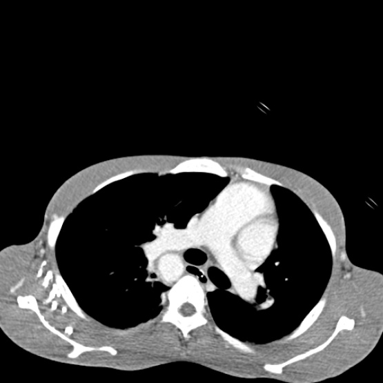 File:Chronic large bowel pseudo-obstruction (Radiopaedia 43181-46492 A 6).jpg