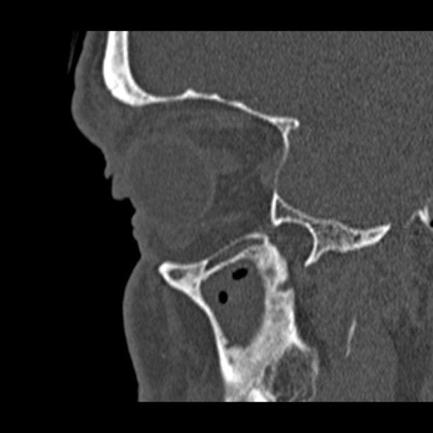 Chronic maxillary sinusitis (Radiopaedia 27879-28116 Sagittal bone window 8).jpg