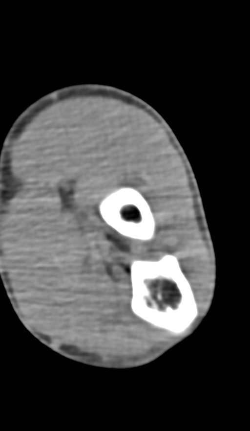 Chronic osteomyelitis of the distal humerus (Radiopaedia 78351-90971 Axial non-contrast 109).jpg