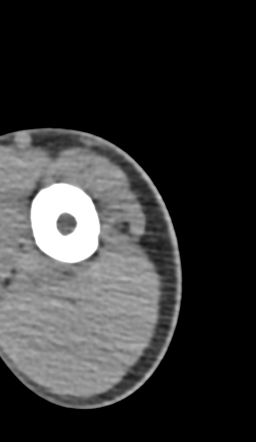 Chronic osteomyelitis of the distal humerus (Radiopaedia 78351-90971 Axial non-contrast 15).jpg