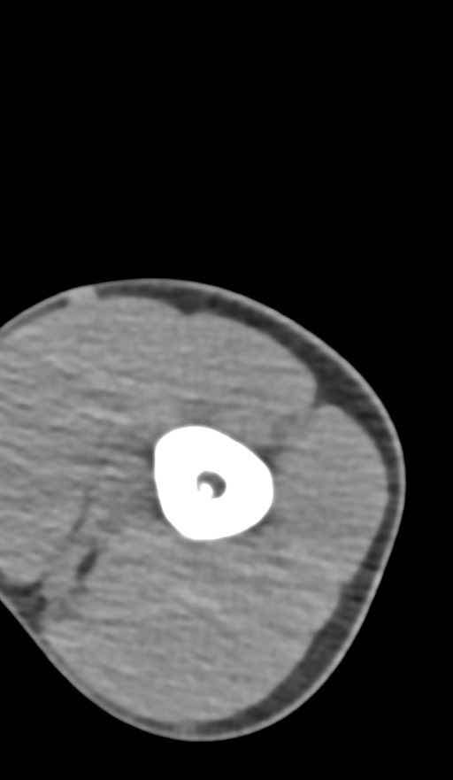 Chronic osteomyelitis of the distal humerus (Radiopaedia 78351-90971 Axial non-contrast 43).jpg