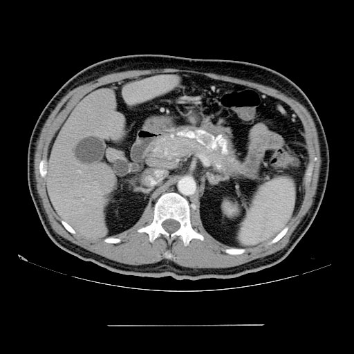 File:Chronic pancreatitis (Radiopaedia 11312-11676 F 1).jpg