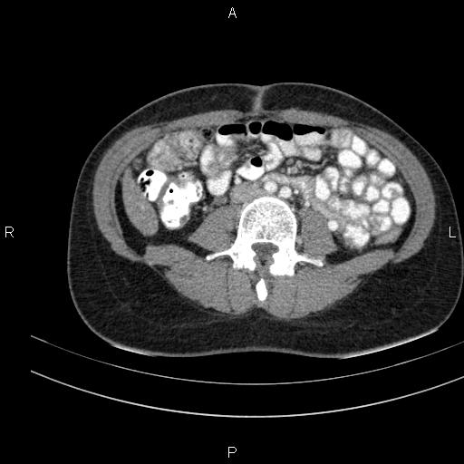 Chronic pancreatitis (Radiopaedia 64576-73450 B 95).jpg