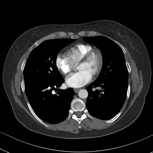 File:Chronic pulmonary embolus (Radiopaedia 39129-41341 Axial C+ CTPA 63).png