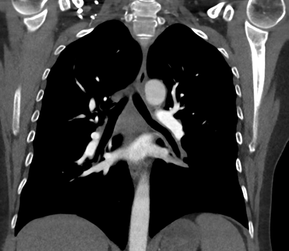 Chronic pulmonary embolus (Radiopaedia 39129-41341 Coronal C+ CTPA 51).png