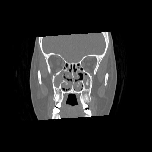 File:Chronic sinusitis with intra-sinus calcification (Radiopaedia 63919-72668 Coronal bone window 13).jpg