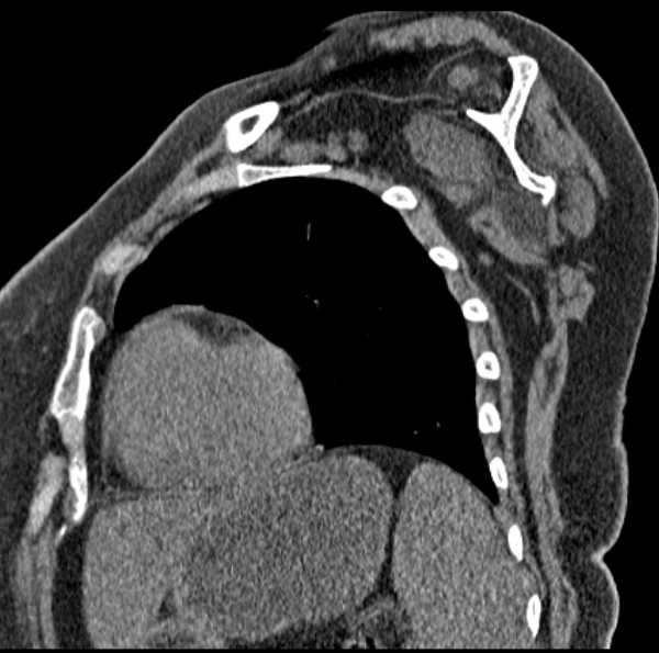 Clear cell chondrosarcoma - humerus (Radiopaedia 63104-71612 D 45).jpg