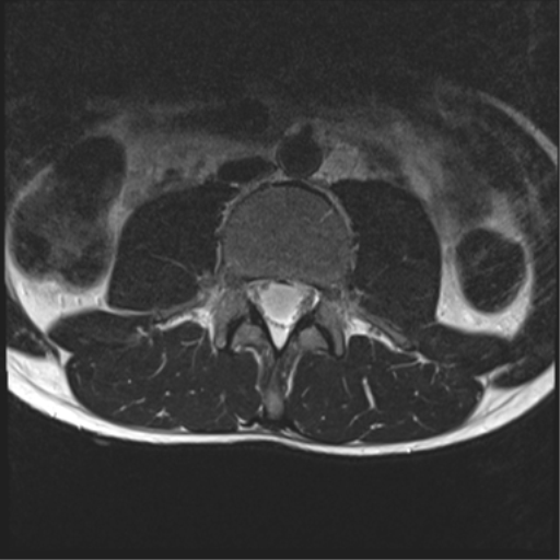 File:Clear cell meningoma - lumbar spine (Radiopaedia 60116-67690 Axial T2 24).png