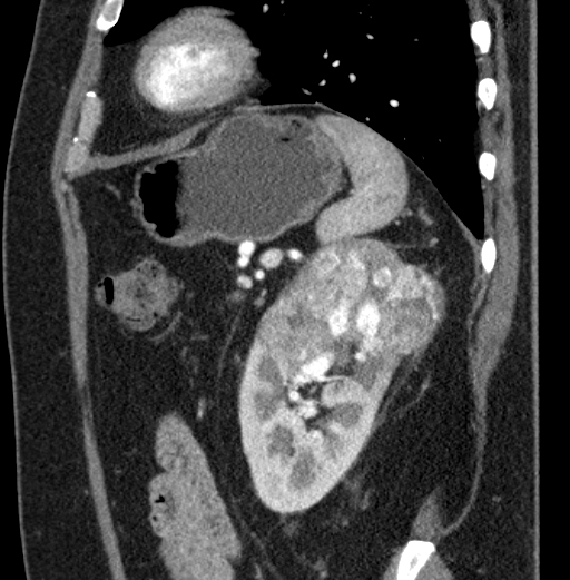 File:Clear cell renal cell carcinoma (Radiopaedia 61449-69393 D 20).jpg