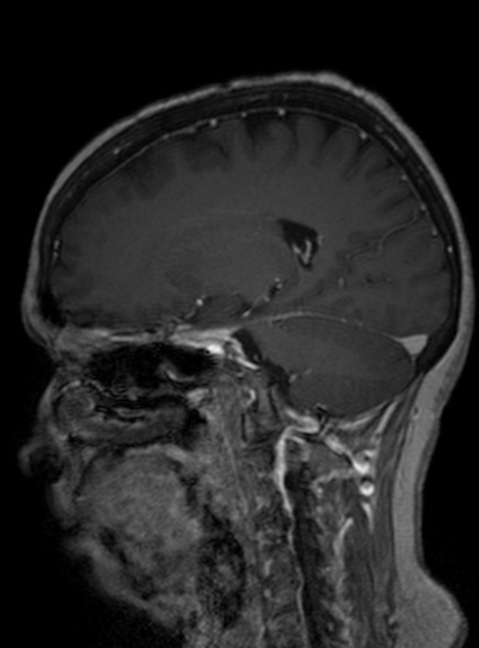 Clival meningioma (Radiopaedia 53278-59248 Sagittal T1 C+ 226).jpg