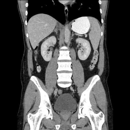 Closed-loop small bowel obstruction (Radiopaedia 73713-84509 C 75).jpg