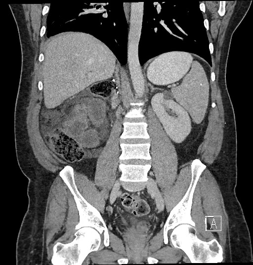 Closed loop obstruction - internal hernia into nephrectomy bed (Radiopaedia 59867-67320 B 87).jpg