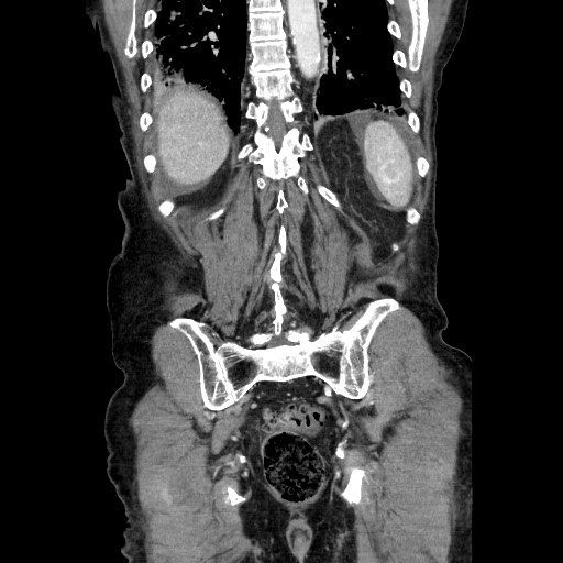 File:Closed loop small bowel obstruction - adhesive disease and hemorrhagic ischemia (Radiopaedia 86831-102990 B 103).jpg