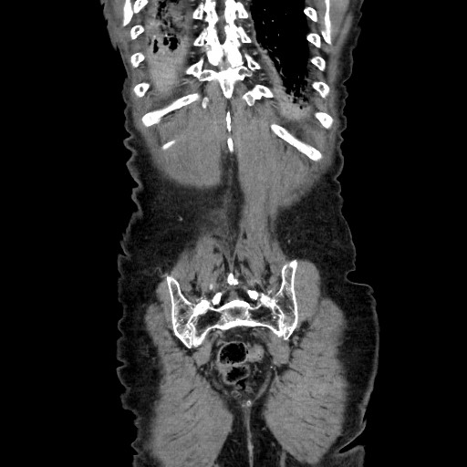 Closed loop small bowel obstruction - adhesive disease and hemorrhagic ischemia (Radiopaedia 86831-102990 B 113).jpg
