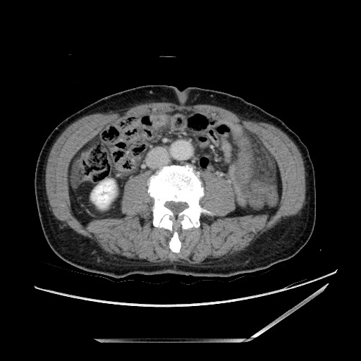 File:Closed loop small bowel obstruction - omental adhesion causing "internal hernia" (Radiopaedia 85129-100682 A 91).jpg