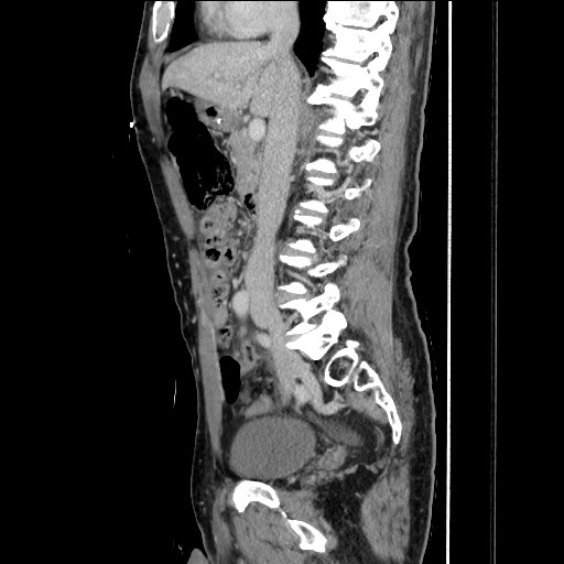 File:Closed loop small bowel obstruction - omental adhesion causing "internal hernia" (Radiopaedia 85129-100682 C 83).jpg