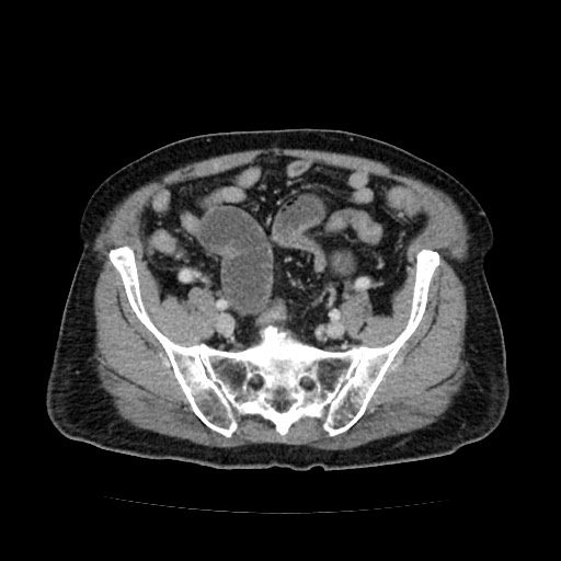 File:Closed loop small bowel obstruction due to adhesive band - U-shaped loop (Radiopaedia 83829-99012 A 51).jpg