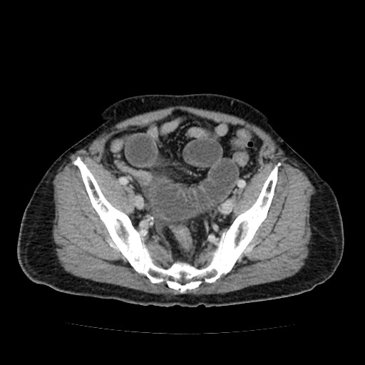 File:Closed loop small bowel obstruction due to adhesive band - U-shaped loop (Radiopaedia 83829-99012 Axial 28).jpg