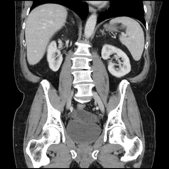 Closed loop small bowel obstruction due to adhesive band - U-shaped loop (Radiopaedia 83829-99012 B 31).jpg