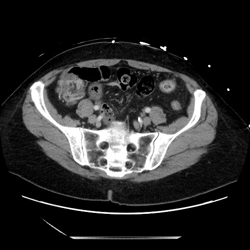Closed loop small bowel obstruction due to adhesive bands - early and late images (Radiopaedia 83830-99014 A 112).jpg