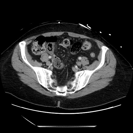 Closed loop small bowel obstruction due to adhesive bands - early and late images (Radiopaedia 83830-99014 A 115).jpg