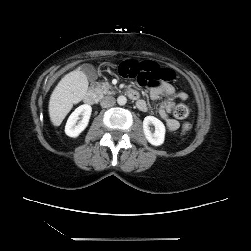 File:Closed loop small bowel obstruction due to adhesive bands - early and late images (Radiopaedia 83830-99014 A 61).jpg