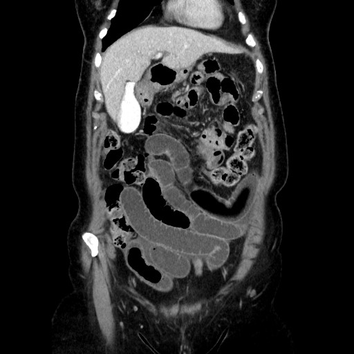 Closed loop small bowel obstruction due to adhesive bands - early and late images (Radiopaedia 83830-99015 B 38).jpg
