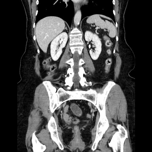 File:Closed loop small bowel obstruction due to adhesive bands - early and late images (Radiopaedia 83830-99015 B 83).jpg