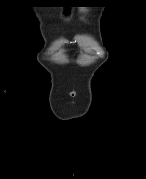Closed loop small bowel obstruction with ischemia (Radiopaedia 84180-99456 B 67).jpg