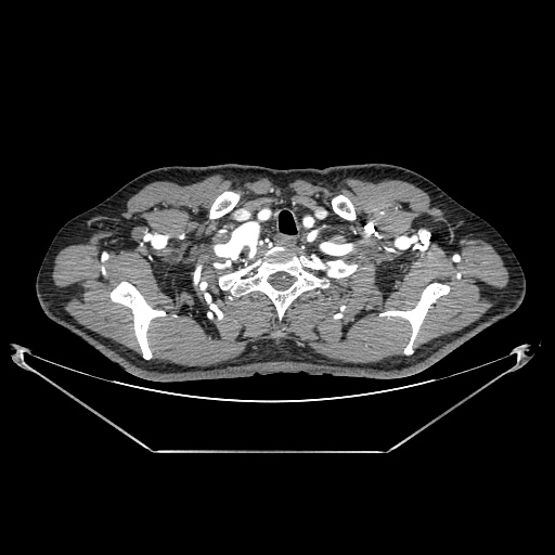 Coarctation of aorta (Radiopaedia 25384-25630 A 1).jpg
