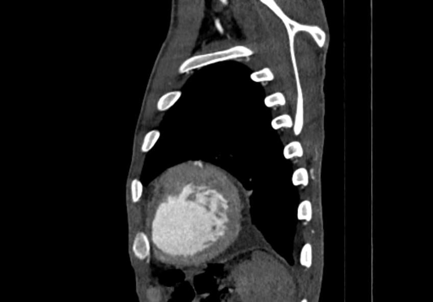 Coarctation of aorta with aortic valve stenosis (Radiopaedia 70463-80574 B 209).jpg