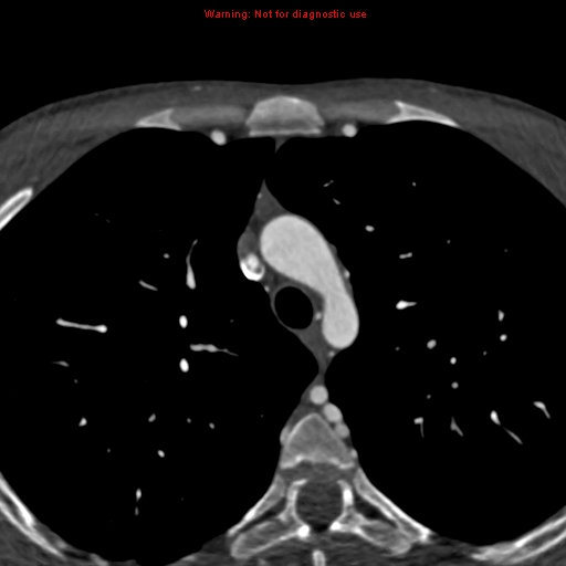 File:Coarctation of the aorta (Radiopaedia 12461-12697 A 68).jpg
