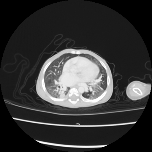Coarctation of the aorta and patent ductus arteriosus (Radiopaedia 68033-77499 Axial lung window 31).jpg