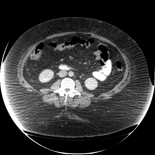 File:Collection due to leak after sleeve gastrectomy (Radiopaedia 55504-61972 A 43).jpg