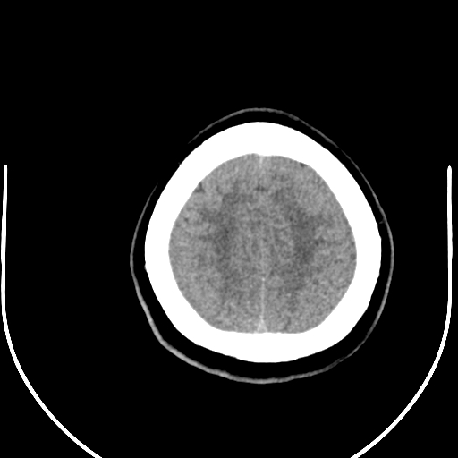 Colloid cyst (Radiopaedia 52865-58792 Axial non-contrast 16).jpg
