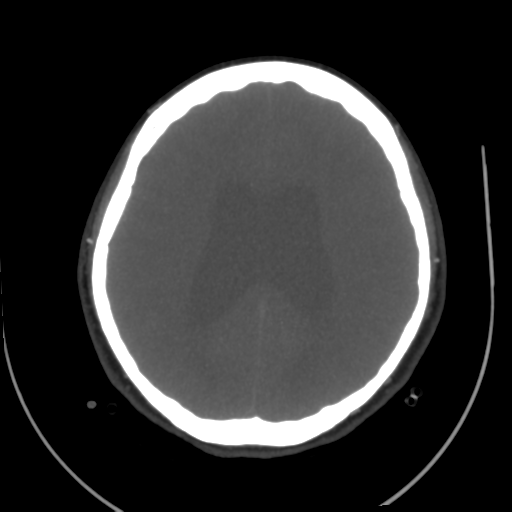 File:Colloid cyst (resulting in death) (Radiopaedia 33423-34499 A 38).png