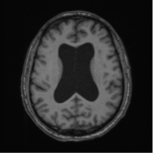 File:Colloid cyst of the third ventricle (Radiopaedia 86571-102662 Axial T1 48).png
