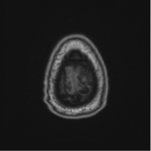 File:Colloid cyst of the third ventricle (Radiopaedia 86571-102662 Axial T1 73).png