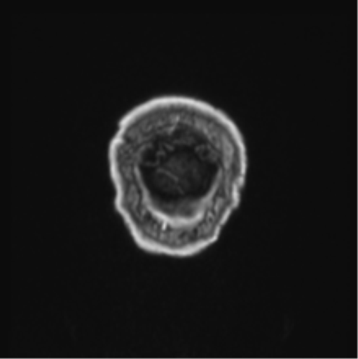 Colloid cyst of the third ventricle (Radiopaedia 86571-102662 Coronal T1 C+ 3).png