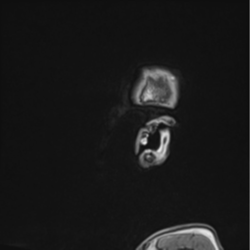 File:Colloid cyst of the third ventricle (Radiopaedia 86571-102662 Sagittal T1 78).png