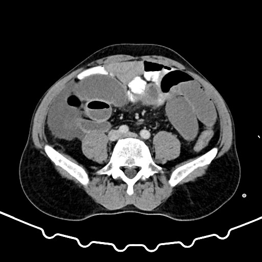 Colocolic intussusception due to large lipoma (Radiopaedia 68773-78482 A 124).jpg